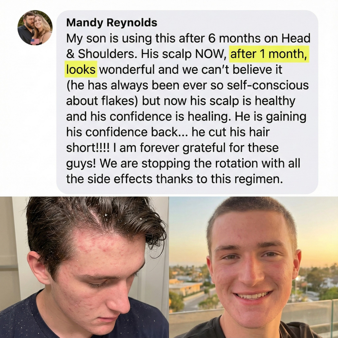 Complete Dandruff Killer System