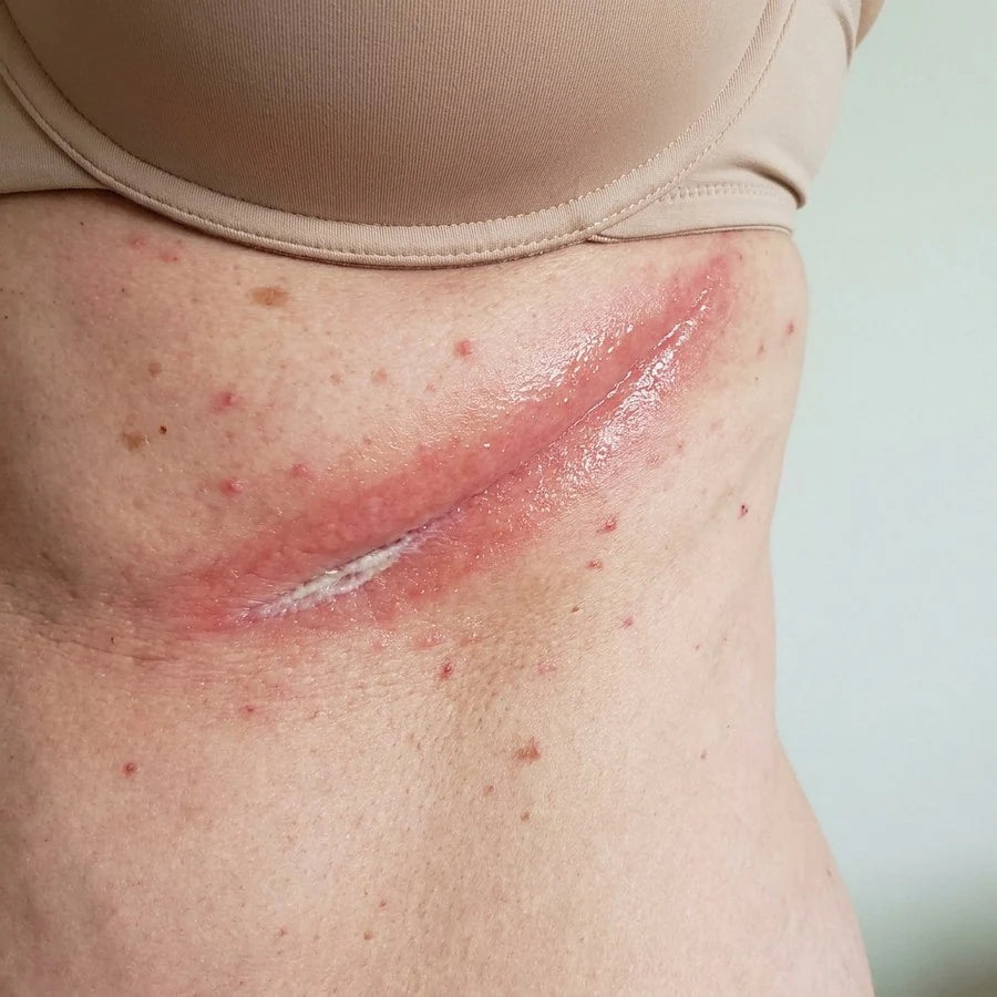 A skin-fold rash under the breast, with five numbered signs